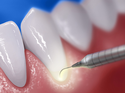 Periodontoloji (Diş Eti Tedavisi)