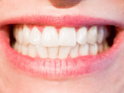 Bruksizm (Diş Sıkma) Tedavisi