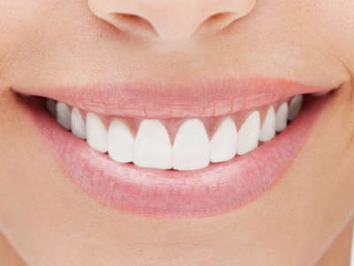 Laminate (Yaprak Porselen)